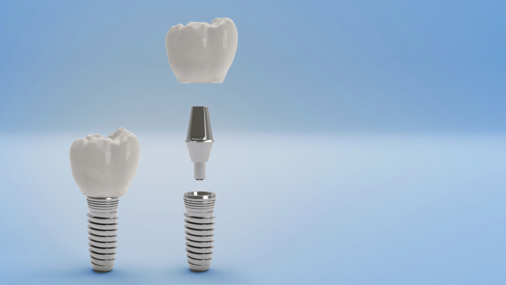 Dental Implant Q&A 