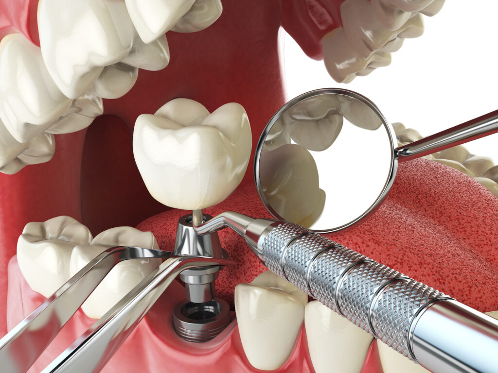 DENTAL IMPLANTS in EAST COBB GA can help restore your bite, but they may not be for everyone